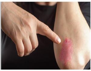 PsoriasisArm